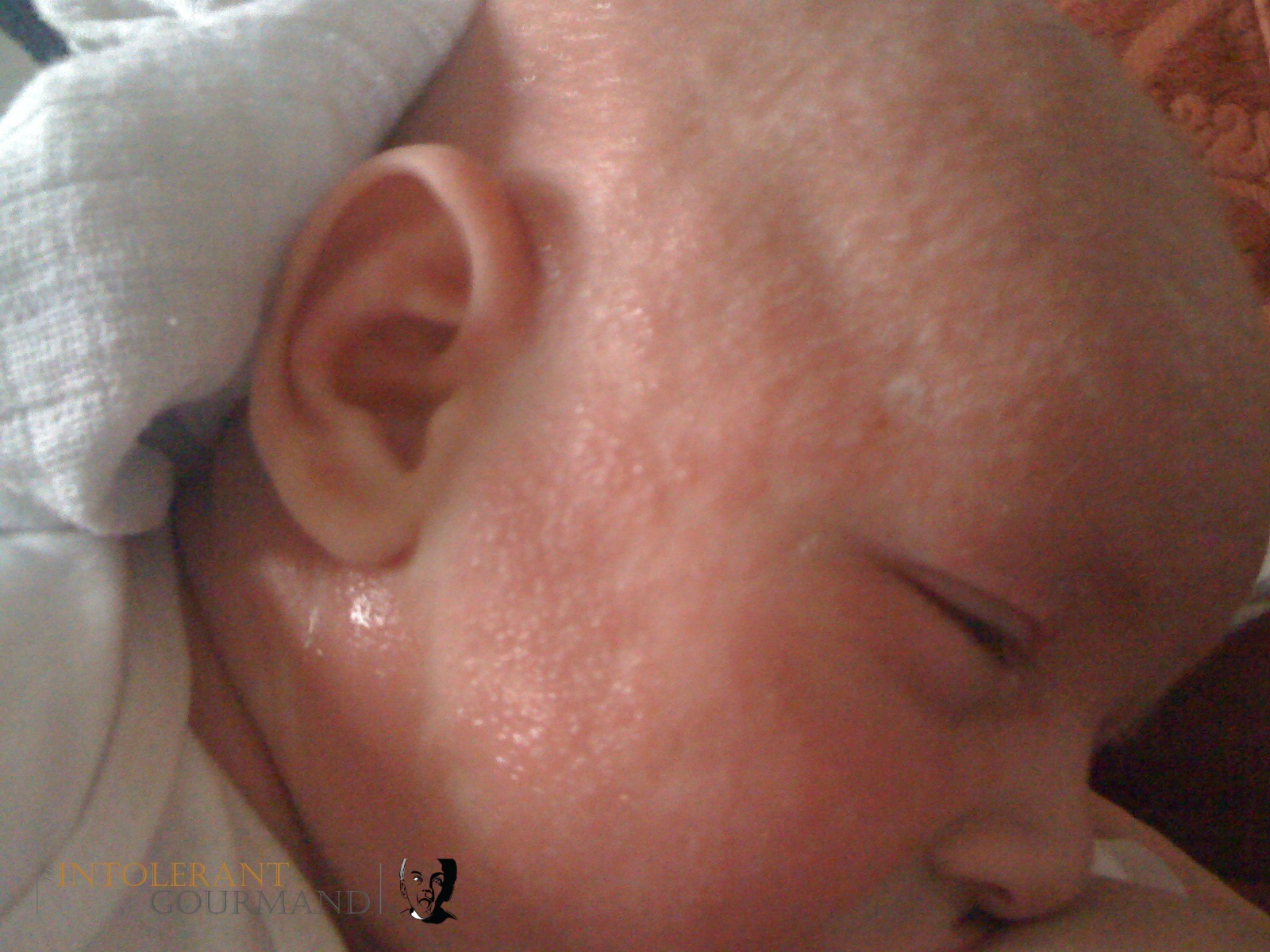 8 weeks old severe reaction - the realities of a severe allergic reaction. Urticaria. Swollen eyes and in fact whole body. Rash. Pus. Difficulty breathing. CMPA. www.intolerantgourmand.com