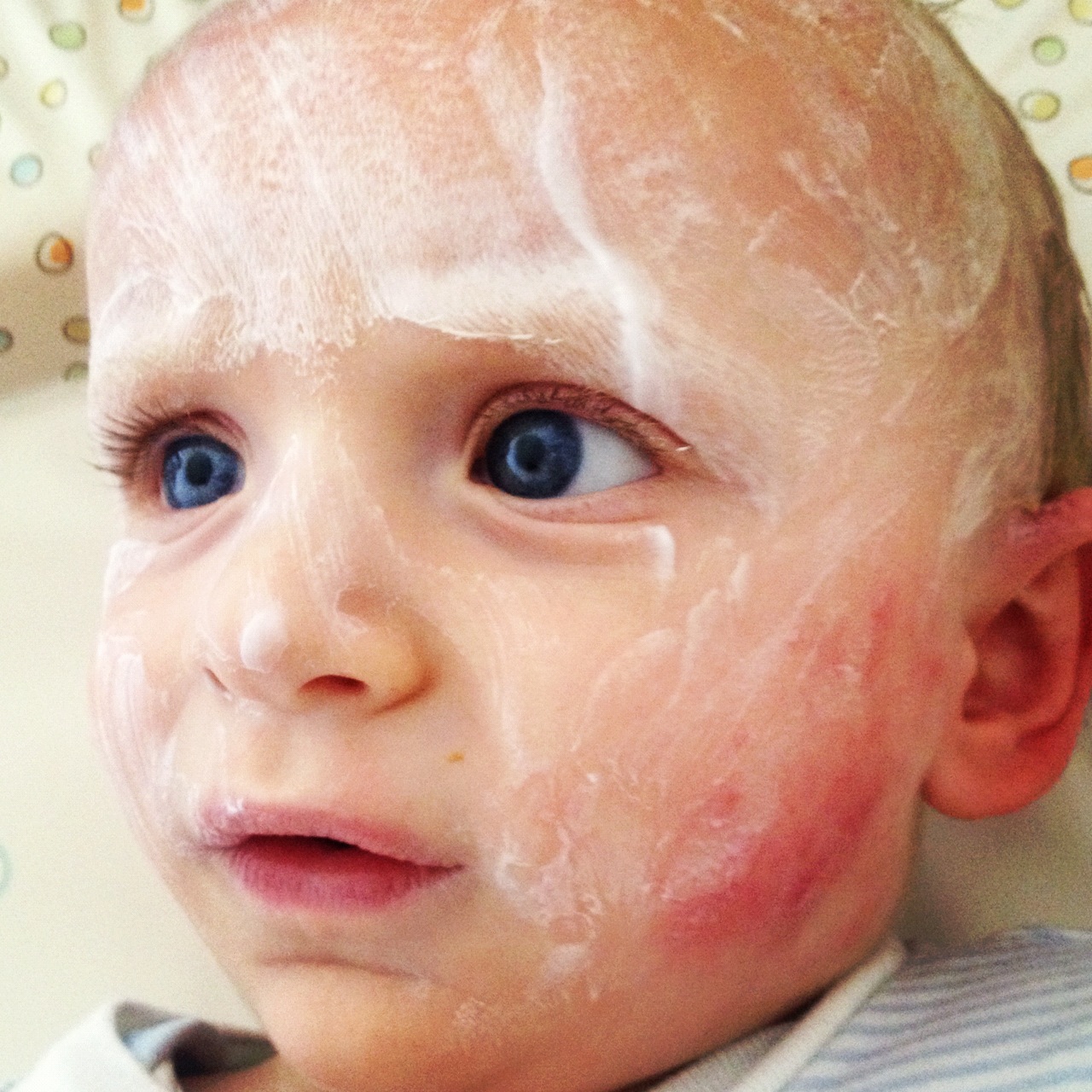 Managing allergies and eczema in cold weather - cold weather can exacerbate eczema symptoms, resulting in dry and irritated skin! Here are my top tips on how to improve and prevent symptoms! (Callum with severe eczema on cheeks) www.intolerantgourmand.com